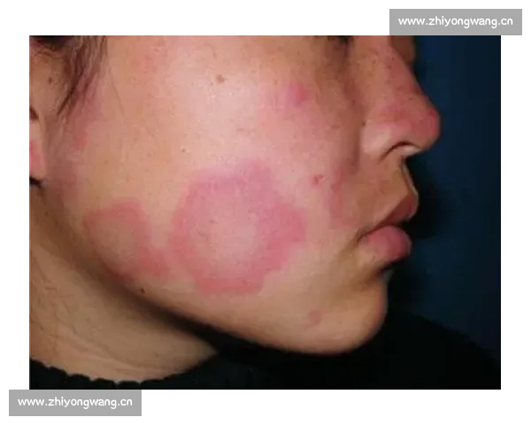 红斑狼疮的早期症状、诊断方法与治疗新进展分析